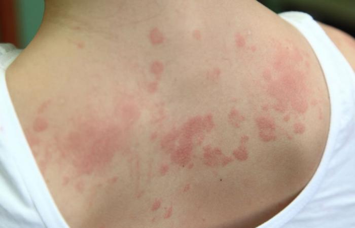 Quels sont les premiers symptômes d’une allergie ?
