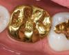 Brunico, le mystère des 268 dents en or trouvées dans une voiture