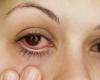 Ouvrez les yeux : campagne de prévention de la sécheresse oculaire