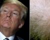 Chute de cheveux, le médicament utilisé par Trump peut provoquer des dysfonctionnements sexuels et des troubles psychiatriques