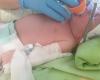 À Foligno, le premier cas de traitement par assistance respiratoire non invasive chez un nouveau-né en détresse respiratoire