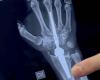 À Bari, la première prothèse de poignet de tout le Sud a été implantée : « Maintenant, le patient bouge le membre et n’a plus de douleur »
