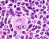 Lymphome à cellules du manteau. L’acalabrutinib associé à une chimio-immunothérapie de première intention réduit le risque de progression de la maladie ou de décès de 27 %